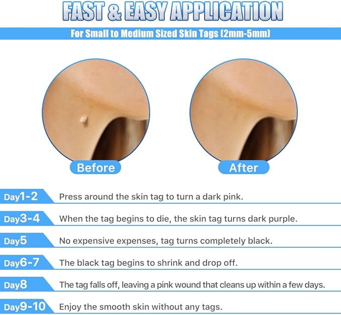 Skin Tag Remover Kit