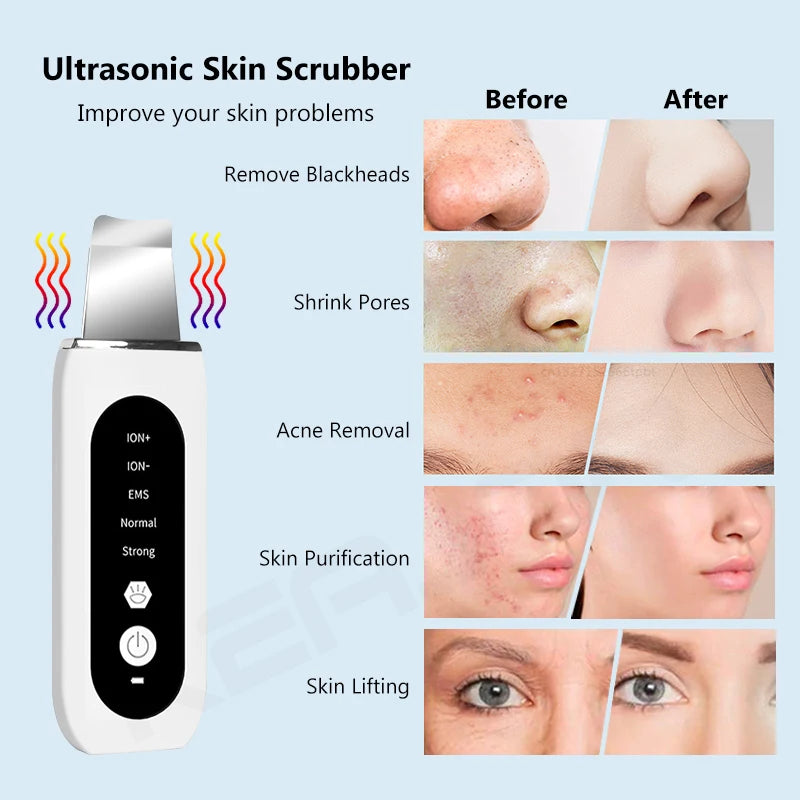 Ultrasonic Face Skin Scrubber EMS Device